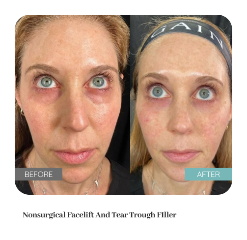 Before and after treatment result — Dr. Lanna, LC Medical Aesthetics NYC